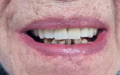 Instalación de implantes dentales en paciente de 80 años