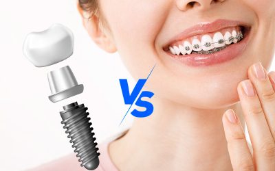 Ortodoncia vs Implantes Dentales: ¿Cuál viene primero?